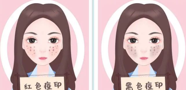臉上紅色痘印幾個(gè)月都不消怎么辦？紅色痘印應(yīng)該怎么消除？