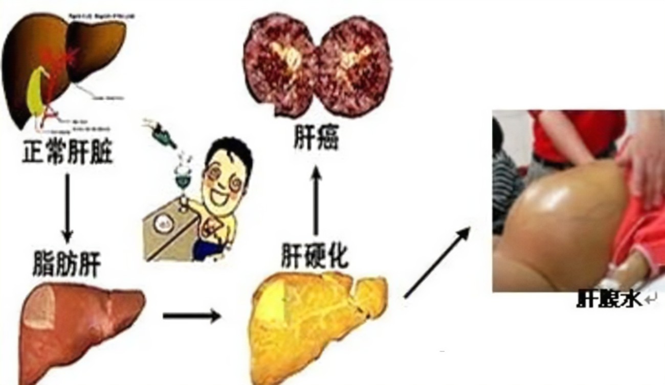 查出肝硬化還有救嗎？