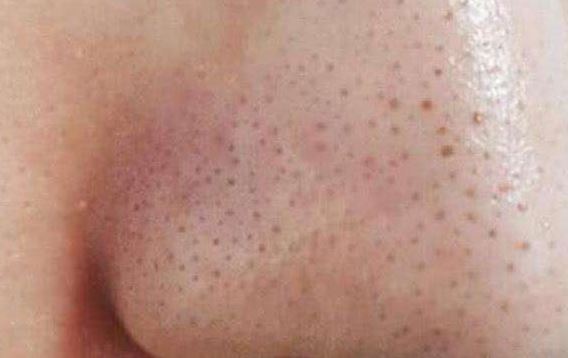 清潔面膜哪個牌子可以快速祛黑頭？趙薇、薇婭 推薦的紐西之謎泥膜真的好用嗎？